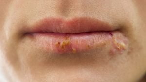 Herpes môi là gì ? triệu chứng và cách chữa herpes môi tại nhà