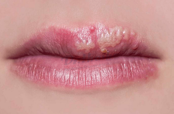 Herpes miệng là gì ? nguyên nhân và biểu hiện của bệnh herpes miệng