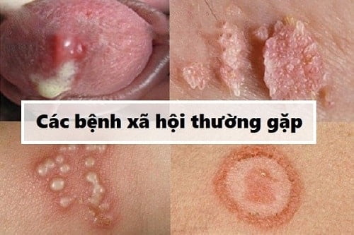 Tổng quan & điều trị các bệnh xã hội: lậu, giang mai, sùi mào gà