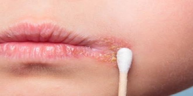 Các câu hỏi thắc mắc thường gặp về herpes và herpes môi