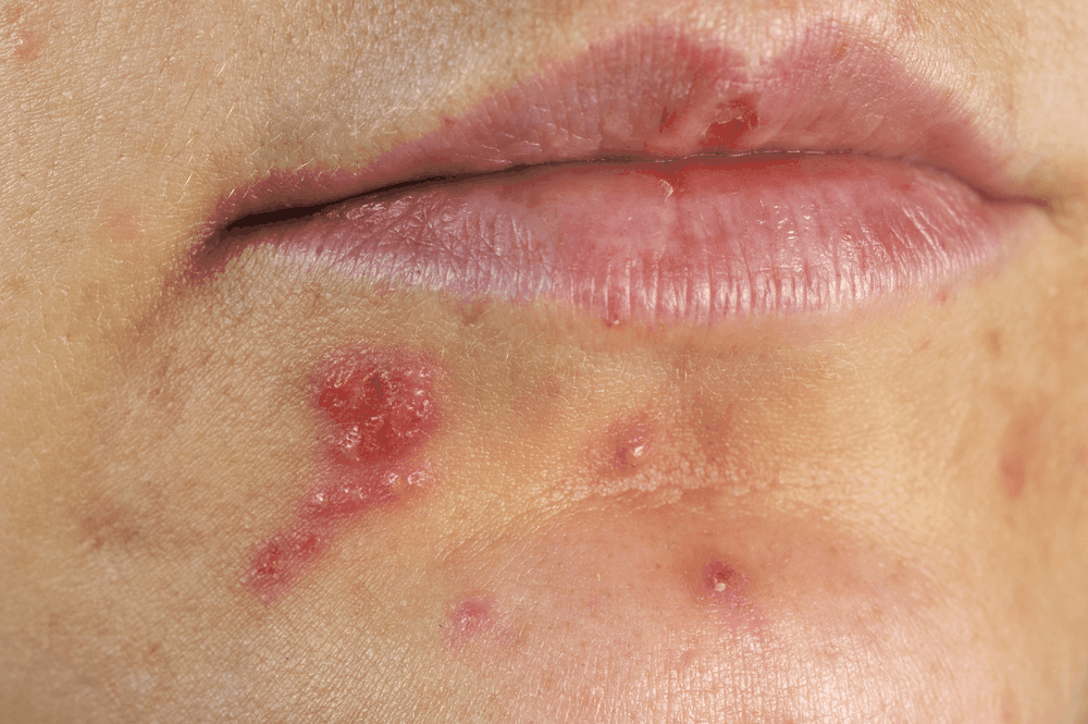 Các dấu hiệu và triệu chứng của nhiễm virus Herpes loại I (HSV-1) | G3VN