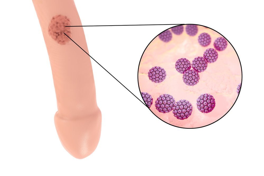 Herpes sinh dục giai đoạn đầu