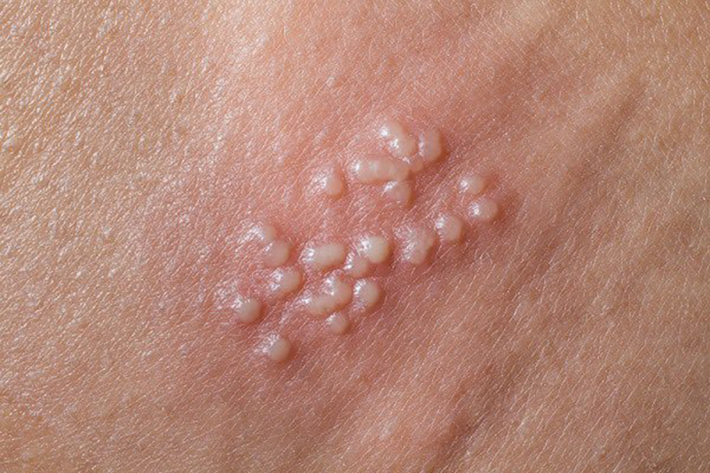 Triệu chứng và nguyên nhân của bệnh Herpes sinh dụ