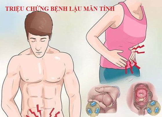 Những dấu hiệu triệu chứng điển hình của bệnh lậu mãn tính