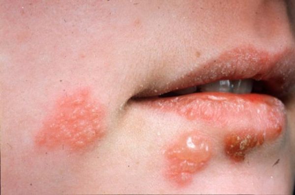 Cách ngăn ngừa herpes miệng tái phát | G3VN