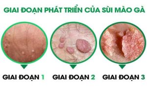 Các giai đoạn chính của bệnh sùi mào gà | G3VN