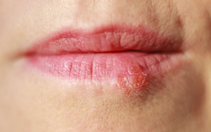 Hướng dẫn cách chữa rộp môi (Herpes môi) nhanh nhất tại nhà | G3VN