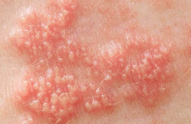 Triệu chứng Herpes sinh dục