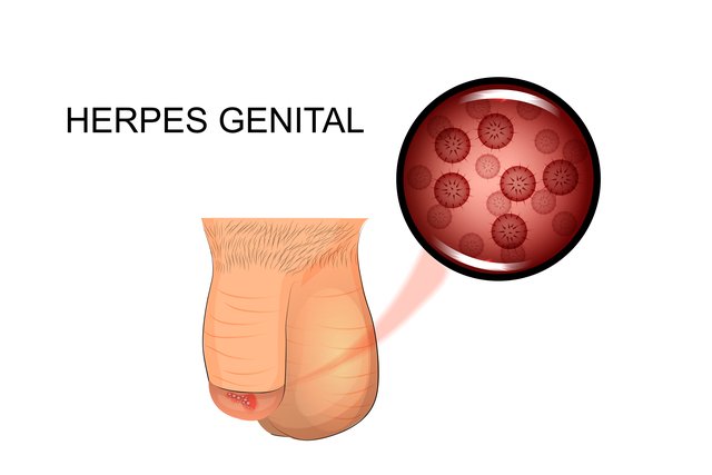 Herpes sinh dục giai đoạn đầu
