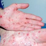 Bệnh giang mai giai đoạn 2: Bạn biết gì về bệnh giang mai ở giai đoạn này?