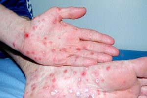 Các triệu chứng và dấu hiệu | G3VN