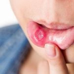 Săng giang mai và mối quan hệ của nó với bệnh giang mai