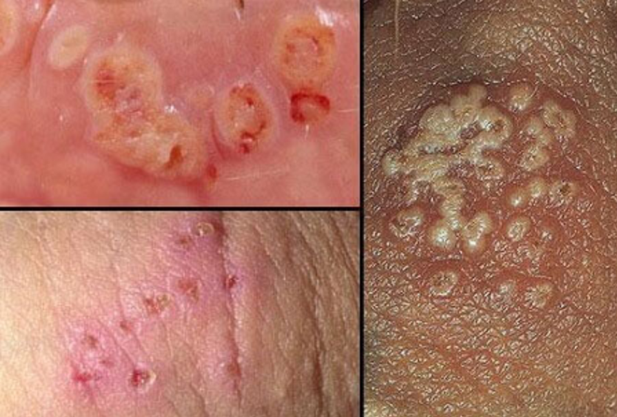 Tổng quan & điều trị các bệnh xã hội: lậu, giang mai, sùi mào gà