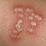 Mụn rộp sinh dục – căn bệnh lạ mà quen