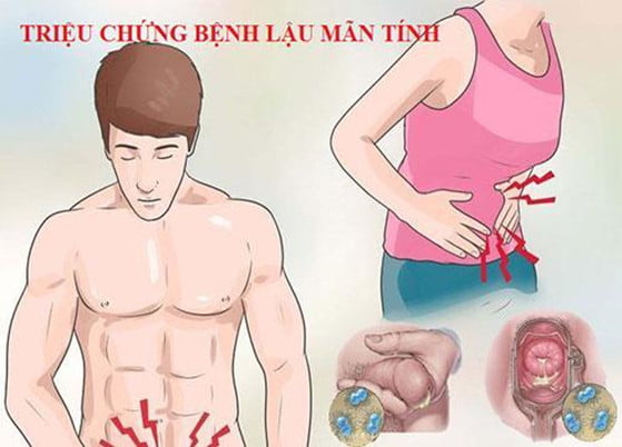 Bệnh lậu mãn tính và các biến chứng, bao lâu thì chuyển sang mãn tính?