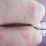 Cách phòng tránh bệnh giang mai hiệu quả?
