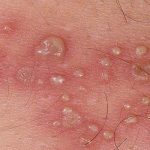 Chlamydia có chữa được không?