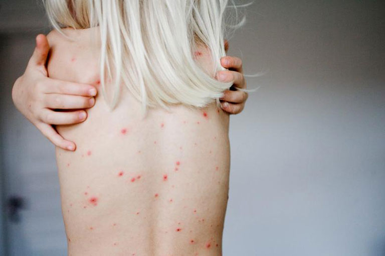 Giang mai âm đạo ở phụ nữ có nguy hiểm không?