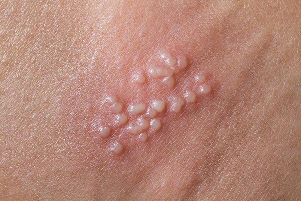 Hơn 15 phương pháp chữa bệnh lậu tại nhà đơn giản, không cần đến bệnh viện