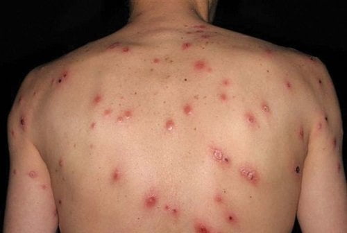 Bệnh giang mai có nguy hiểm không