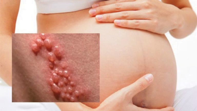 Cách điều trị cho thai phụ khi bị nhiễm lậu | G3VN