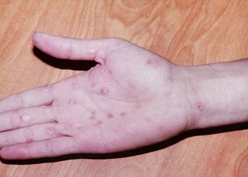Bệnh lậu và những điều ít người biết