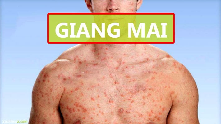 Phân biệt giang mai với Viêm niệu đạo | G3VN