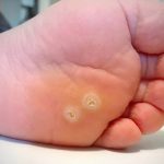 Dấu hiệu nhiễm HPV: nhận biết càng sớm càng dễ điều trị