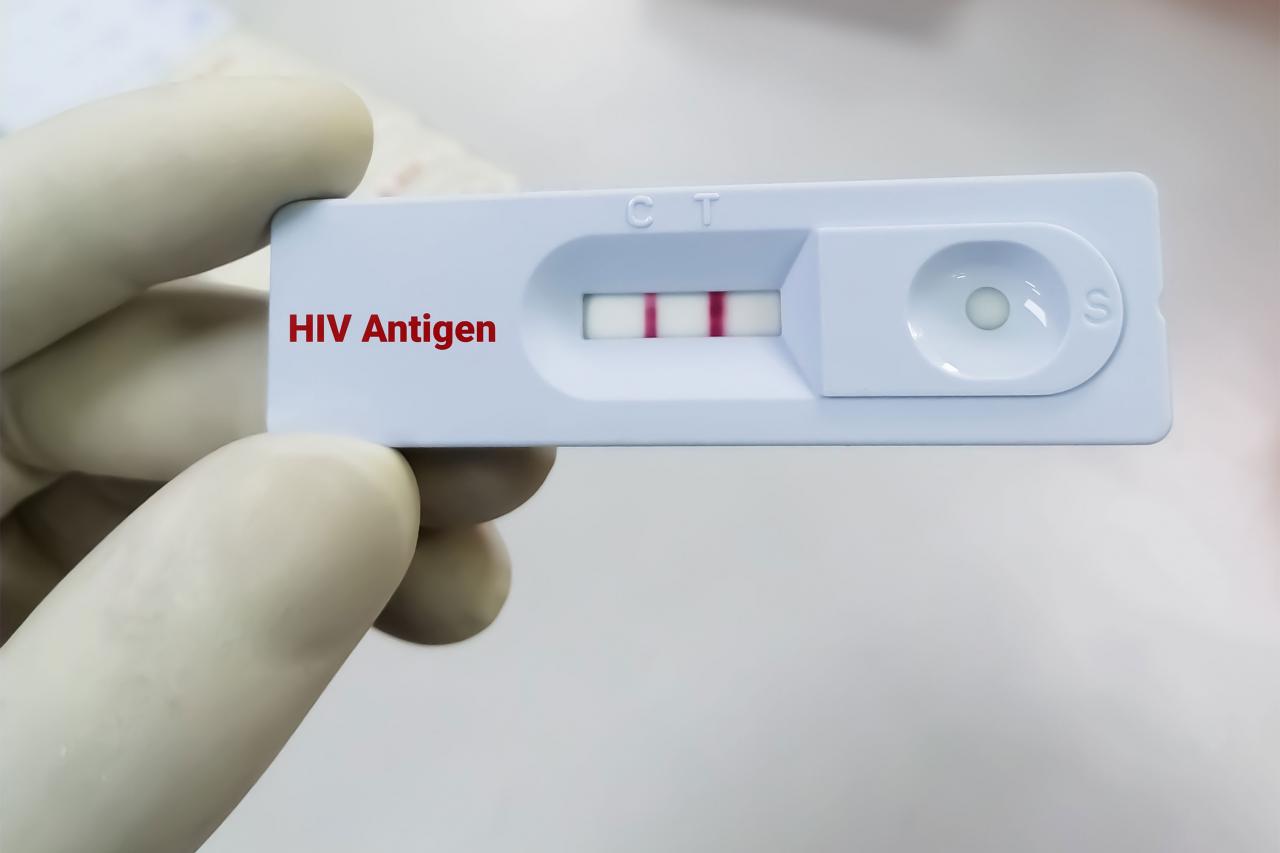 Tại sao cần thực hiện xét nghiệm HIV | G3VN