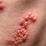 Bệnh mụn rộp sinh dục ở giai đoạn đầu có nguy hiểm không?
