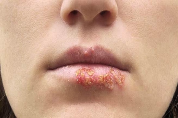 Bị mụn rộp sinh dục ở miệng, các triệu chứng và cách phòng bệnh
