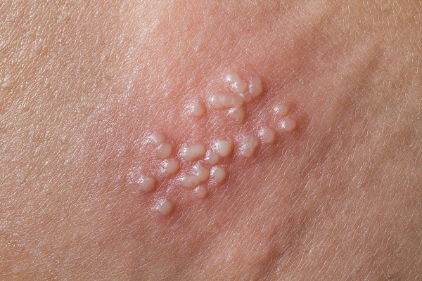 Phân biệt lậu với Viêm niệu đạo | G3VN