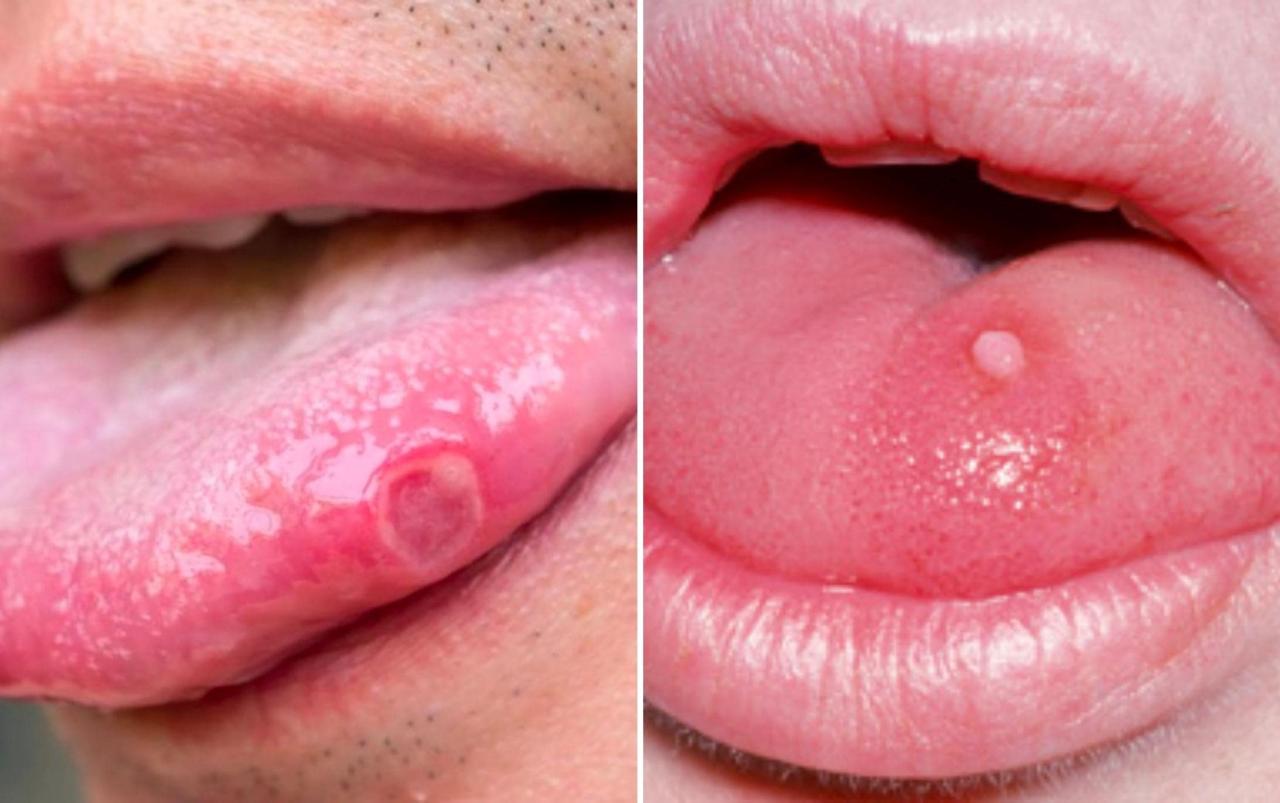 Sùi mào gà ở lưỡi: 10 hình ảnh điển hình, dấu hiệu, chữa trị