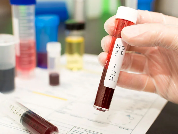 Xét nghiệm elisa là gì? cách thực hiện xét nghiệm elisa HIV